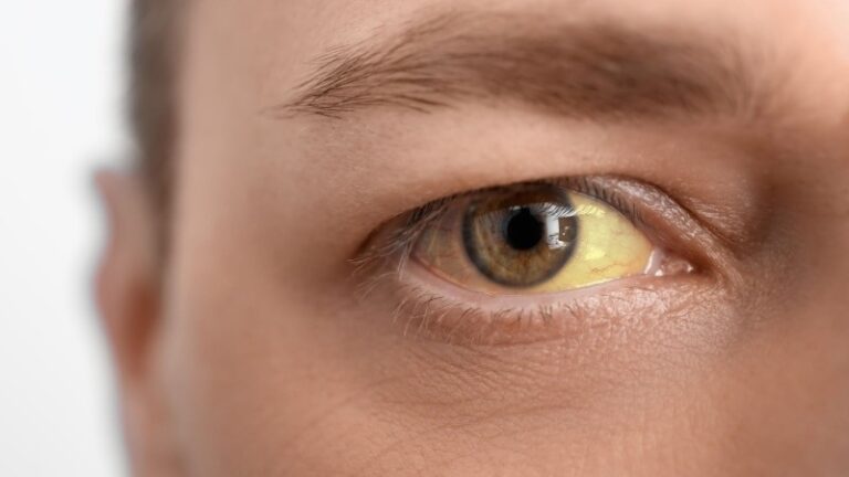 Gula ögon – vad är värt att veta?